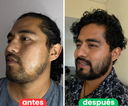 Bálsamo para Crecimiento de Barba Ultra Potente con Minoxidil 20% | 100mL 🔥